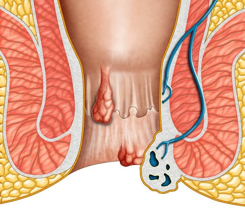 Điều trị trĩ ở Buôn Ma Thuột nhanh khỏi