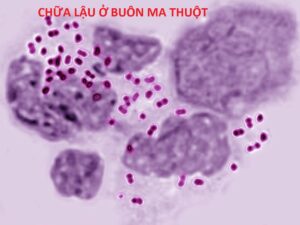 Chữa lậu ở Buôn Ma Thuột