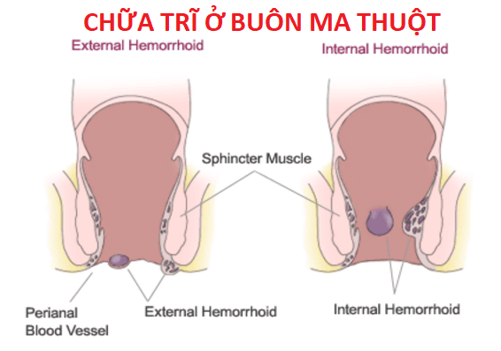 Chữa trĩ ở Buôn Ma Thuột