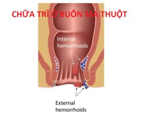 Chữa trĩ ở Buôn Ma Thuột