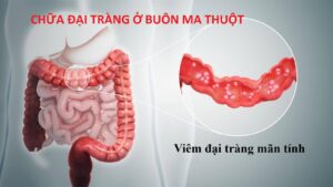 Chữa đại tràng ở Buôn Ma Thuột